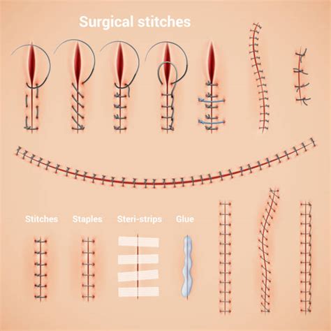 Sutures Illustrations Royalty Free Vector Graphics And Clip Art Istock