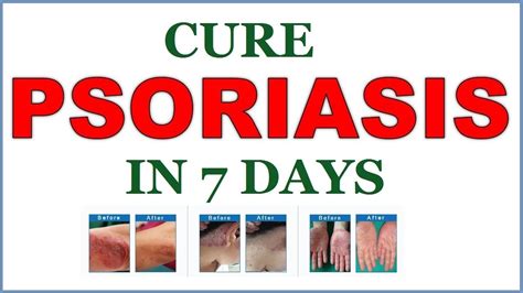Cure Psoriasis In 7 Days How To Cure Psoriasis Psoriasis Treatment