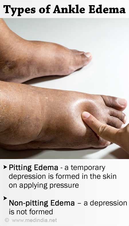 Om De Stiinta Adaptare Wetland What Causes Pitting Edema In Legs And
