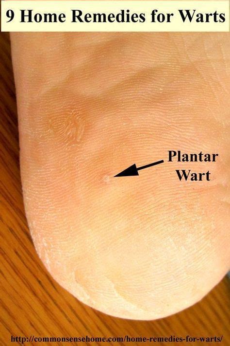 9 Home Remedies For Warts Cheap And Easy To Use These Diy Treatments