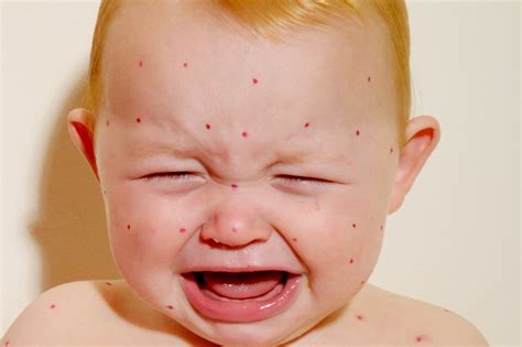 What To Look Out For And What To Do If Your Child Has Chicken Pox