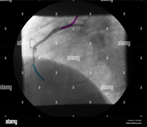 Stent Herz Fotos Und Bildmaterial In Hoher Auflösung Alamy