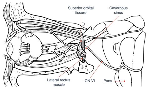 Moran Core Cranial Nerve Vi Palsies