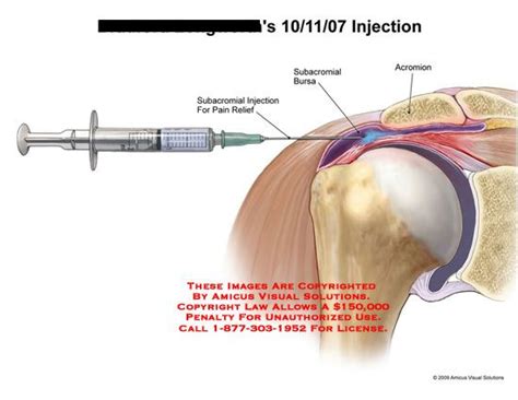 Subacromial Injection With Needle Administering Pain Relief