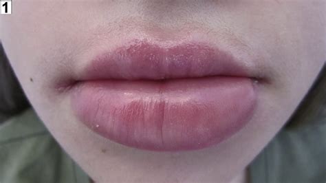 Upper Lip Swelling At Night