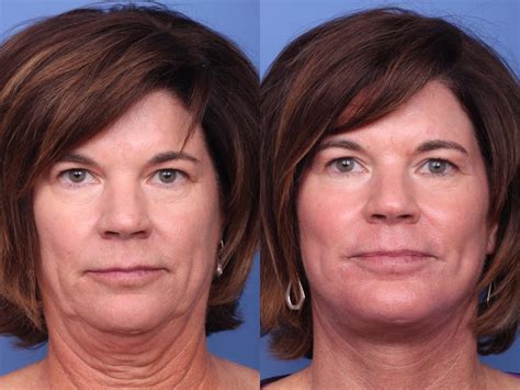 Facelift Before And After Pictures Case 127 Scottsdale Az Hobgood Facial Plastic Surgery