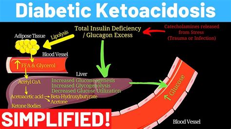 Diabetic Ketoacidosis Detailed Explanation Within 7 Minutes Diabetic