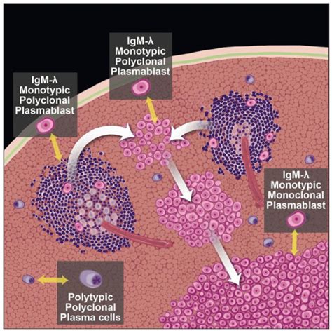 Plasmablastic Lymphoma Arising In Hhv8 Multicentric Castleman Disease
