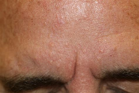 bumpy skin sebaceous hyperplasia and electrocautery by deborah tosline — skin remodeling diy