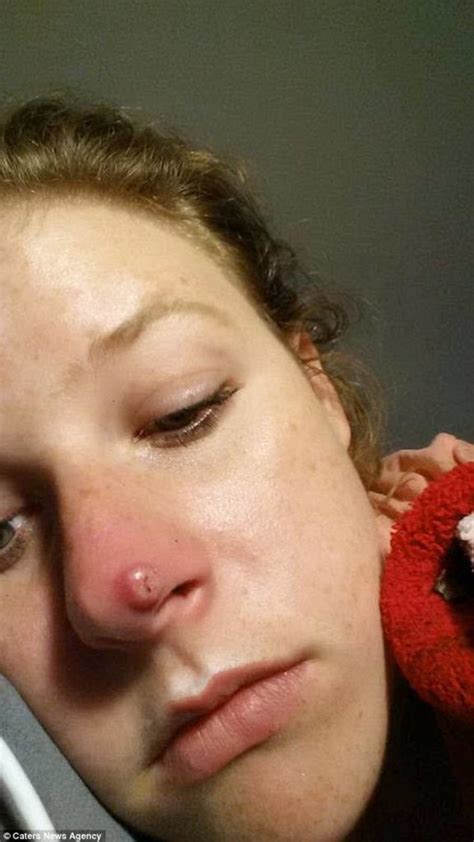 She Thought It Was Just A Pimple Then It Nearly Destroyed Her Face