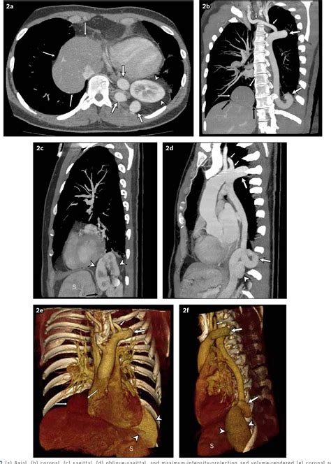 Figure 1 From Bilateral Bochdalek Hernias Associated With Severe Aortic