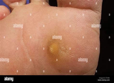 Viral Wart Hi Res Stock Photography And Images Alamy