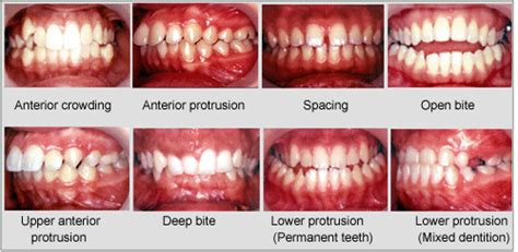 Retainer memegang gigi di posisi sehingga serat dan gigitan anda stabil. Kenapa perlu cabut gigi sebelum pakai braces @ pendakap ...