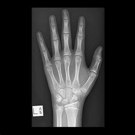 Wrist X Rays
