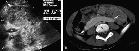 Horseshoe Kidney A Ultrasound Coronal Longitudinal Plane Two