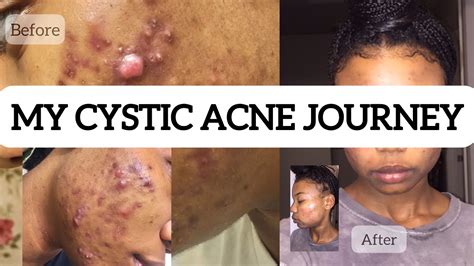 How I Cleared My Cystic Acne Using Retin A Tretinoin W Photos Youtube