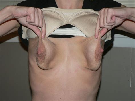 Misshapen Breasts Sex Pictures Pass