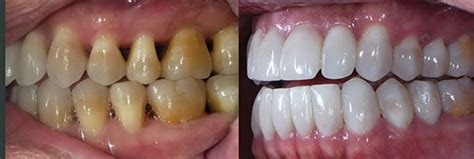 Full Mouth Black Triangle Treatment Protocol Dentistry Today