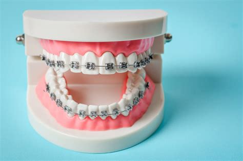 Popular Myths About Metal Braces L Simply Orthodontics Holliston