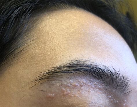 Bumps Under My Eyebrow I Noticed I Get More After Plucking My Hairs