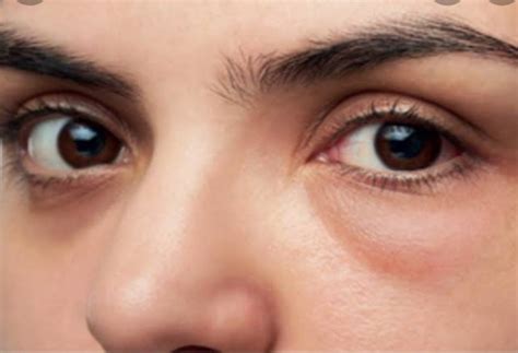 Understand The Causes Of Puffy Eyes And Find Relief Nikon