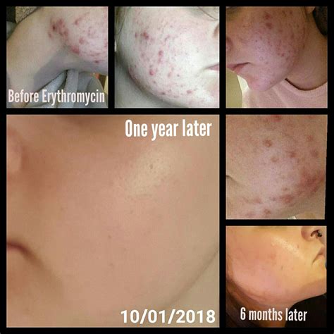 [Before & After] My acne one year later! : SkincareAddiction