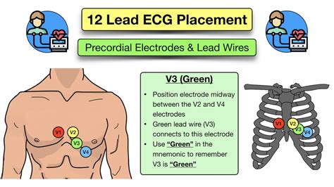 12 Lead Ecg Placement Diagram And Mnemonic For Limb And Precordial