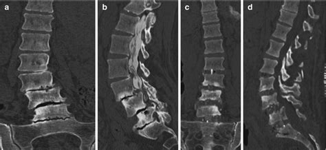 Anterior Column Support Options For Adult Lumbar Scoliosis Musculoskeletal Key