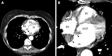 Contrast Enhanced Multislice Computed Tomography Ct Of The Thorax