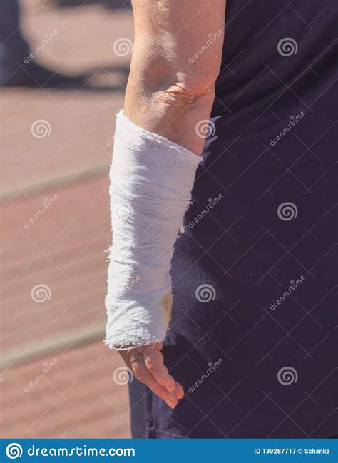 A Broken Arm In A Woman S Cast Stock Image Image Of
