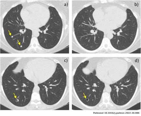 Benign Metastasizing Leiomyoma Presenting As Multiple Pulmonary Nodules