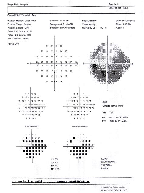 Community Eye Health Journal Visual Field Testing For Glaucoma A
