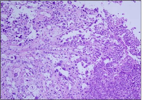 Histologic Findings Shows Moderately Differentiated Squamous Cell