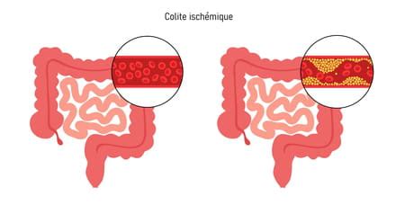 Ischemic Colitis Signs Causes How To Treat