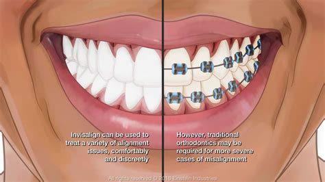 How To Know If You Need Braces Or Invisalign Everything You Need To Know About Invisalign Omar