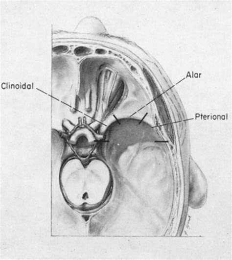 Meningiomas Of The Sphenoidal Ridge In Journal Of Neurosurgery Volume