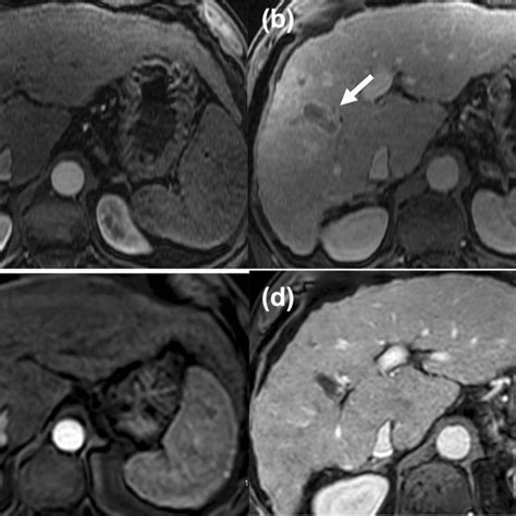 Axial Post Contrast T1 Weighted Fat Saturated Images In The Arterial