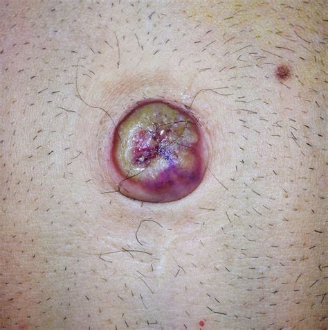 We did not find results for: A bleeding umbilical mass | Gut