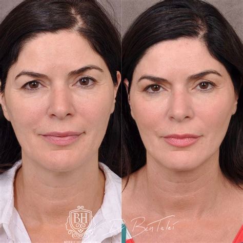 Profound Rfskin Tightening Before And Afters Beverly Hills Center