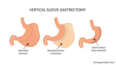Sleeve Gastrectomy Safer Than Gastric Bypass At 5 Years But Is It
