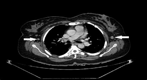 Ct Scan Of Chest Showing Bilateral Enlarged Axillary Lymph Nodes