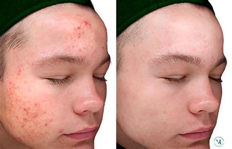 Acid Peel Before And After