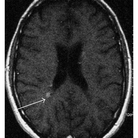 Brain And Spinal Cord Mri Of The Patient With Cmtx And Ms And Brain Mri