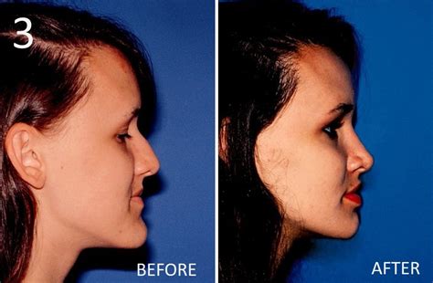 Rhinoplasty Salt Lake City Plastic Surgery Center Of Utah