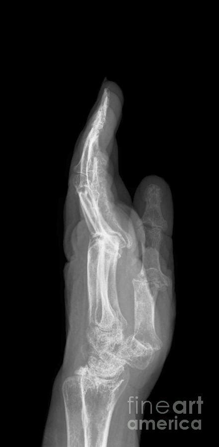 Arthritic Hand X Ray Photograph By Science Photo Library