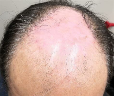 おでこが後退!おでこハゲ状態の生え際に増毛をするとこれ ...