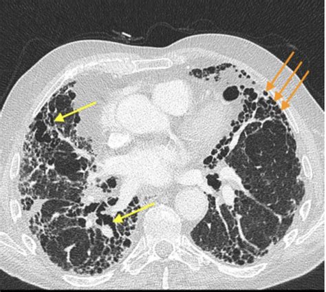 Diffuse Parenchymal Lung Disease Flashcards Quizlet