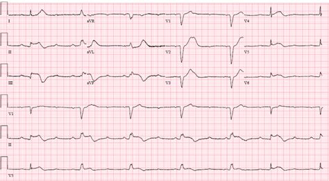 Extensive Coronary Thrombus In Patients Presenting With Stemi And Covid