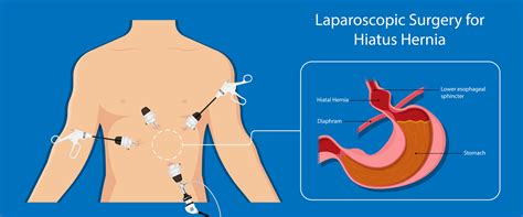 Fundoplication — Hepatobiliary And Upper Gastrointestinal Surgery