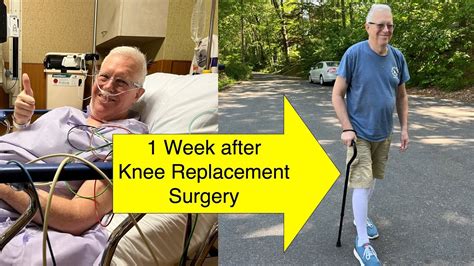 1 Week After Knee Replacement Youtube